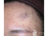 Before